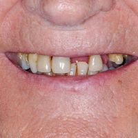 Implants and Crowns before